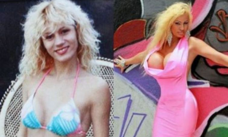 Lacey Wildd Before & After Plastic Surgery